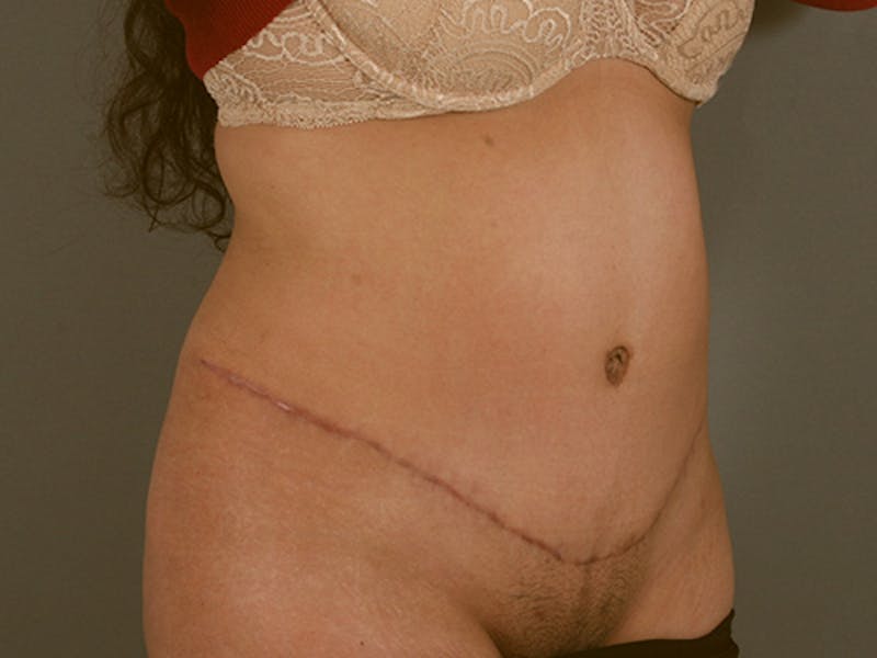 Tummy Tuck Before & After Gallery - Patient 12880315 - Image 4