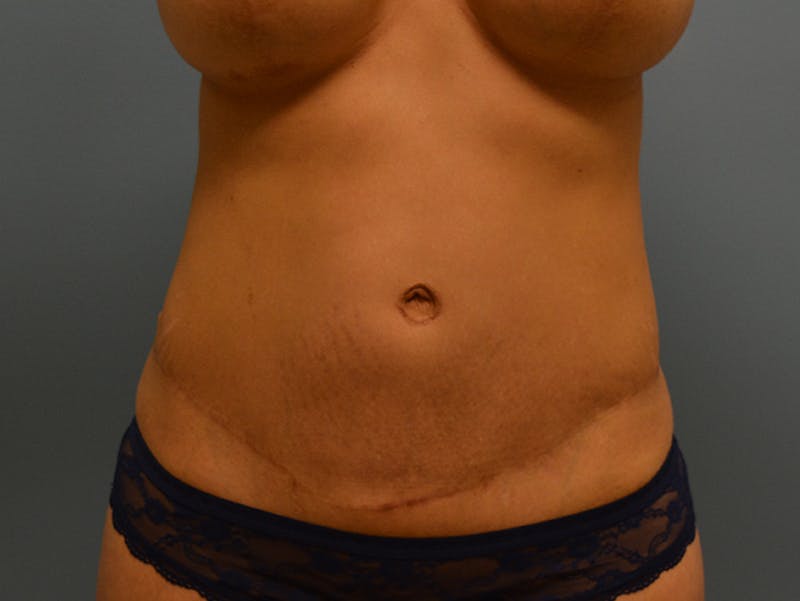 Mommy Makeover Before & After Gallery - Patient 12898830 - Image 12