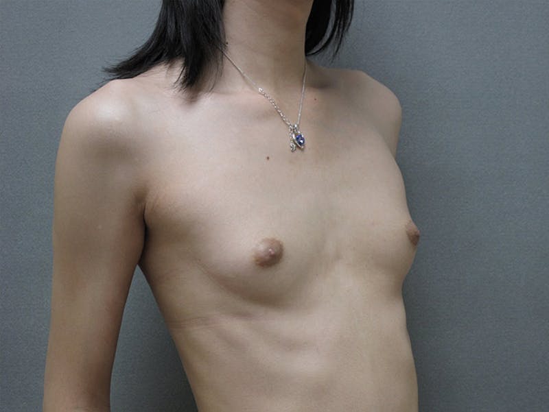 Breast Augmentation Before & After Gallery - Patient 12880316 - Image 5