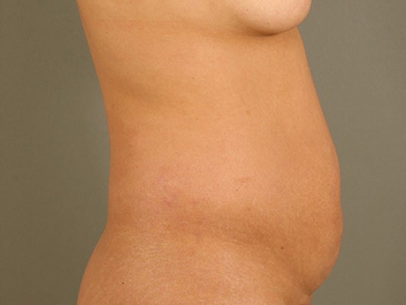 Tummy Tuck Gallery - Patient 12880315 - Image 5