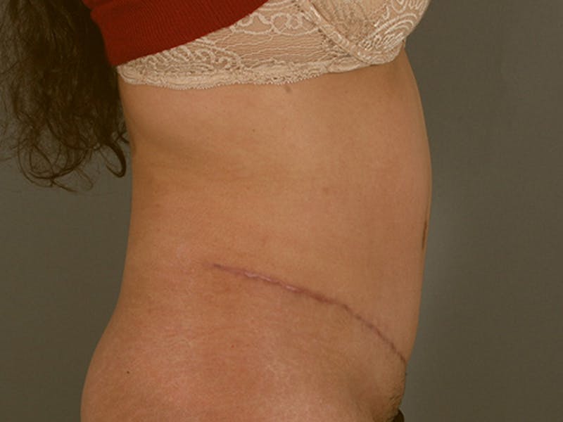 Tummy Tuck Before & After Gallery - Patient 12880315 - Image 6