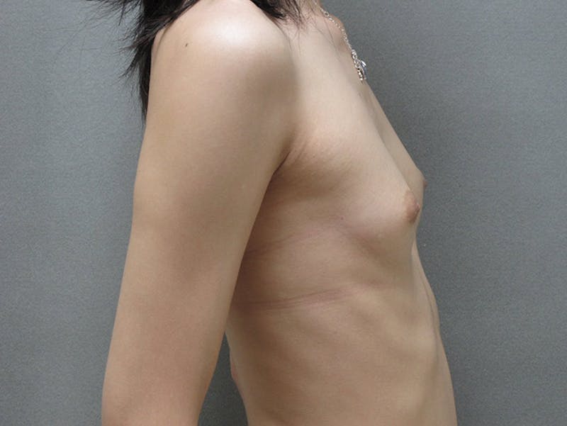 Transgender Breast Augmentation Before & After Gallery - Patient 12880316 - Image 7