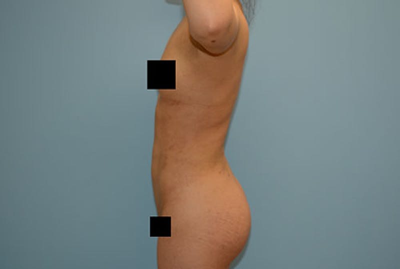 Liposuction Before & After Gallery - Patient 12880313 - Image 6