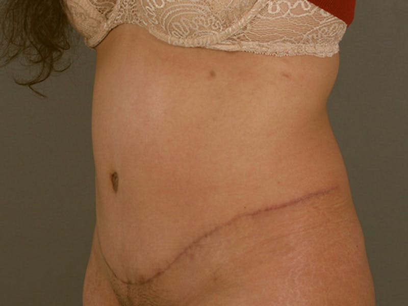 Tummy Tuck Before & After Gallery - Patient 12880315 - Image 8