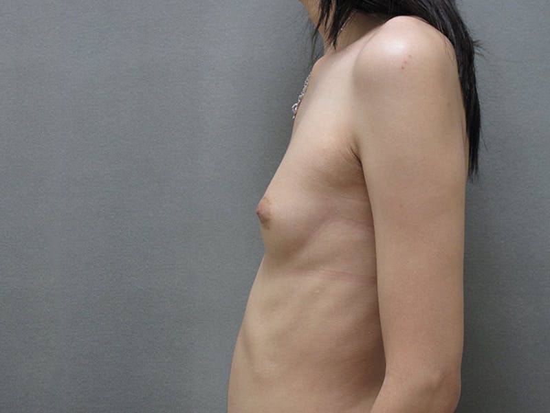 Transgender Breast Augmentation Before & After Gallery - Patient 12880316 - Image 9
