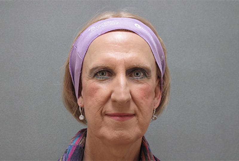 Facial Feminization Before & After Gallery - Patient 12898834 - Image 1