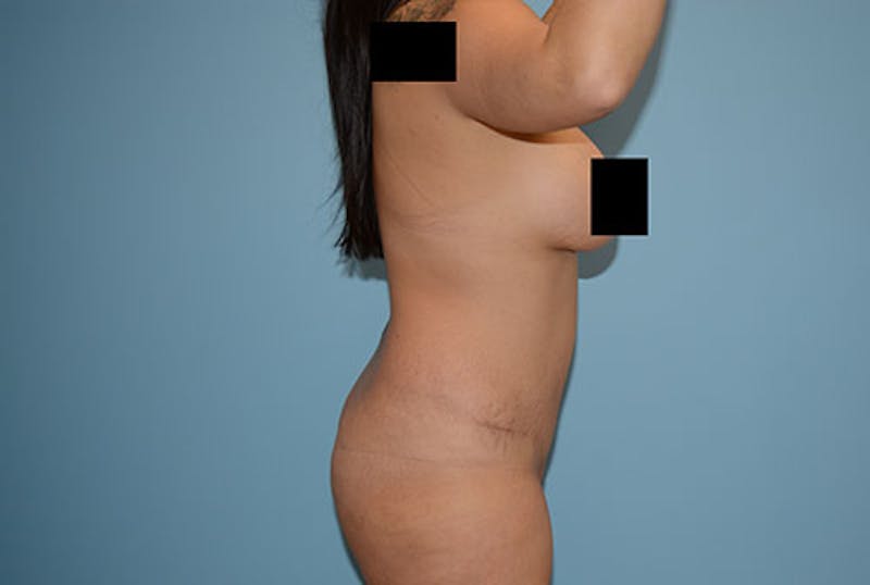 Liposuction Before & After Gallery - Patient 12898835 - Image 3