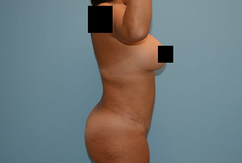 Liposuction Before & After Gallery - Patient 12898835 - Image 4