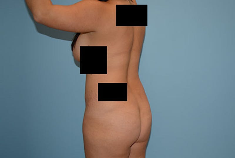 Liposuction Before & After Gallery - Patient 12898835 - Image 5