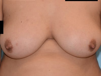 Top Surgery Before & After Gallery - Patient 12898831 - Image 1