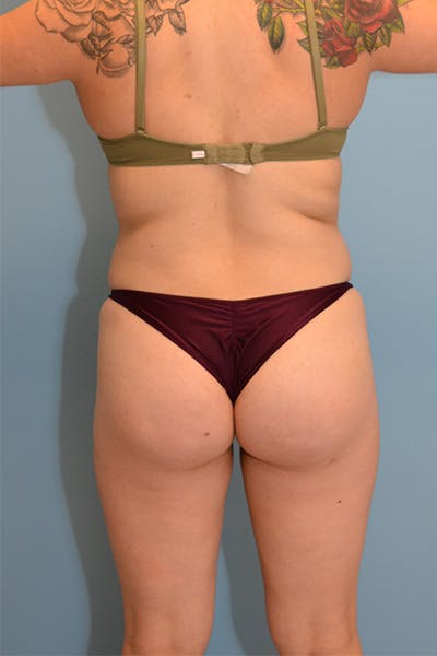 Brazilian Butt Lift Before & After Gallery - Patient 12898832 - Image 1