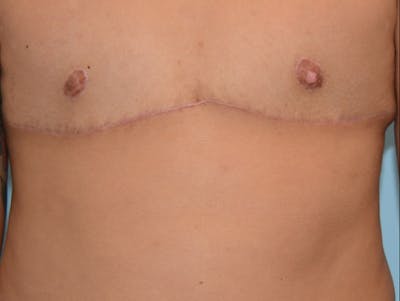 Top Surgery Before & After Gallery - Patient 12898831 - Image 2