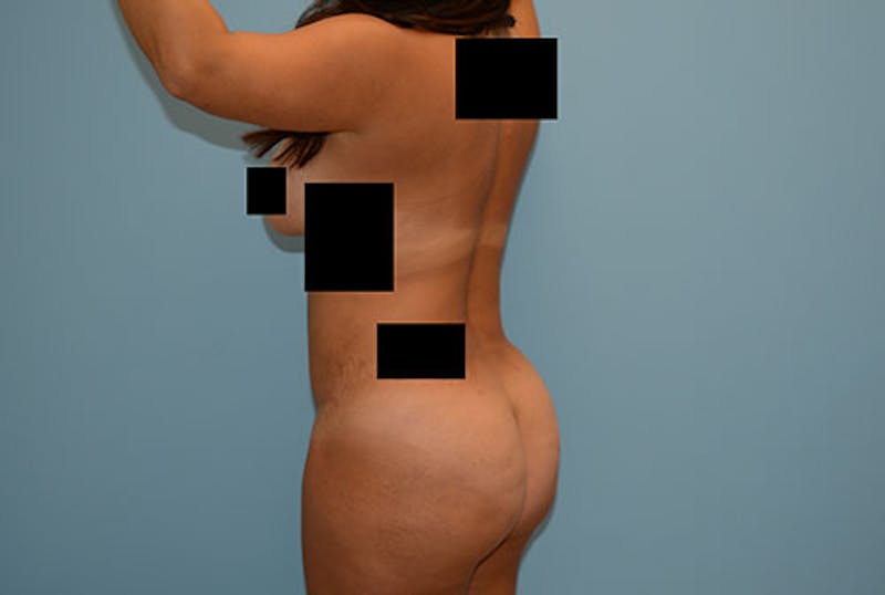Liposuction Before & After Gallery - Patient 12898835 - Image 6