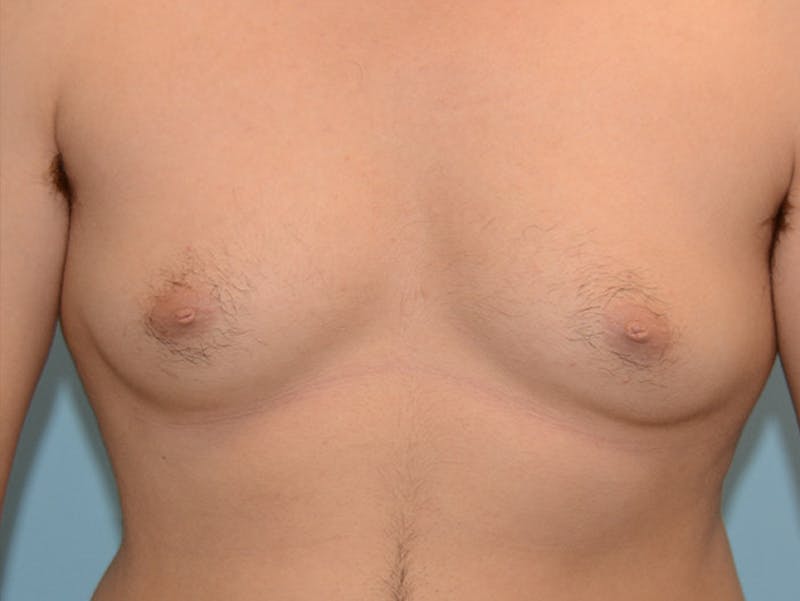 Top Surgery Before & After Gallery - Patient 12898839 - Image 1