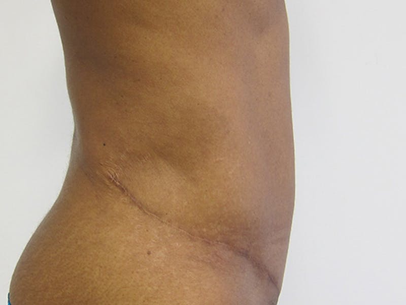 Tummy Tuck Before & After Gallery - Patient 12898838 - Image 6