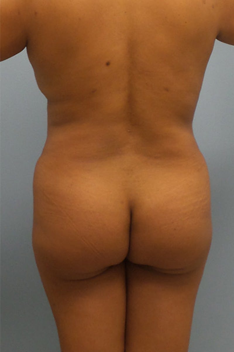 Brazilian Butt Lift Before & After Gallery - Patient 12898840 - Image 1