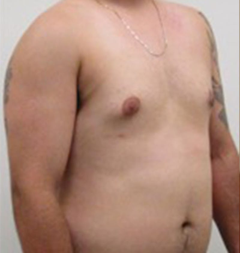 Gynecomastia Before & After Gallery - Patient 12898837 - Image 4