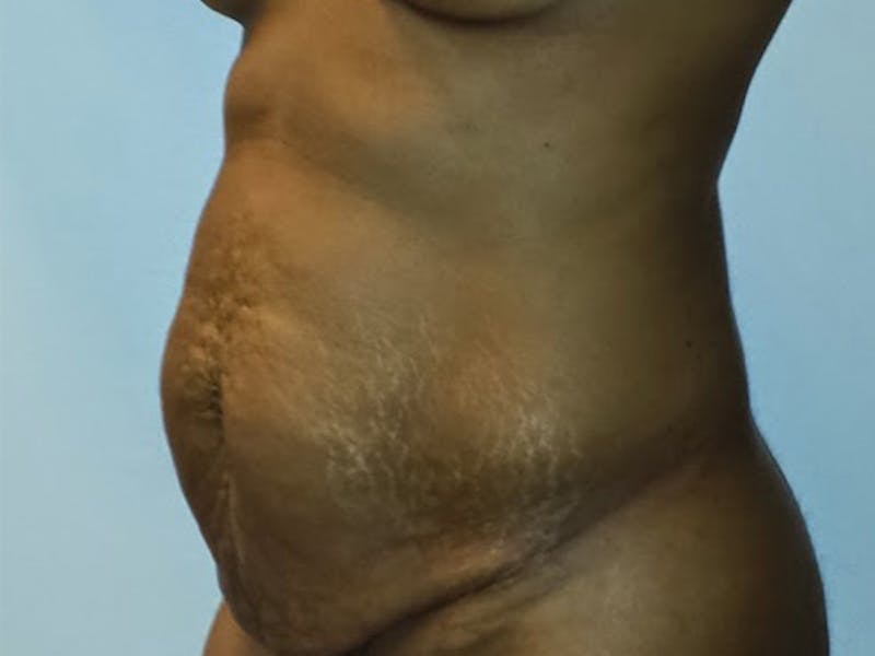Tummy Tuck Before & After Gallery - Patient 12898838 - Image 7