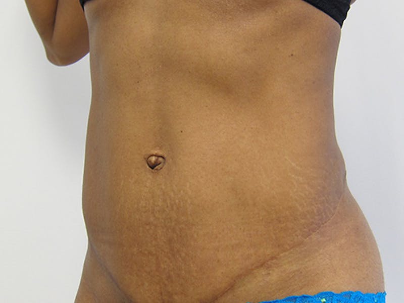 Tummy Tuck Before & After Gallery - Patient 12898838 - Image 8