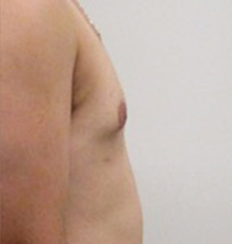Gynecomastia Before & After Gallery - Patient 12898837 - Image 6