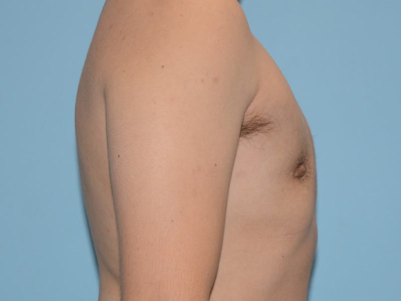Top Surgery Before & After Gallery - Patient 12898839 - Image 4