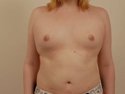 Transgender Breast Augmentation Before & After Gallery - Patient 12898847 - Image 1