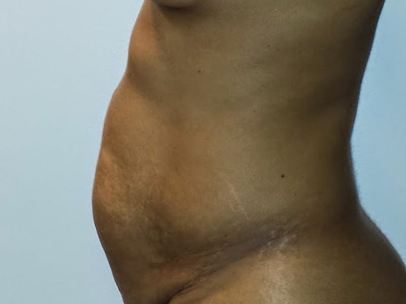 Tummy Tuck Before & After Gallery - Patient 12898838 - Image 9