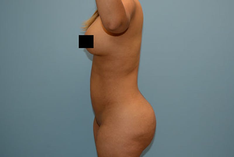 Liposuction Before & After Gallery - Patient 12898842 - Image 4