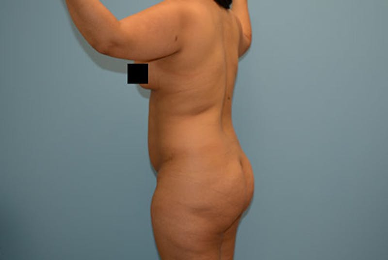 Liposuction Before & After Gallery - Patient 12898842 - Image 5