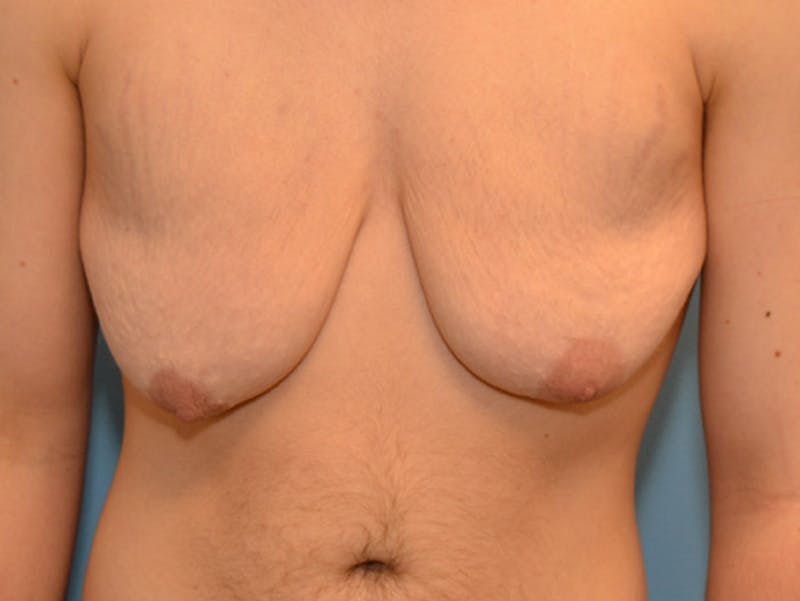 Top Surgery Before & After Gallery - Patient 12898845 - Image 1