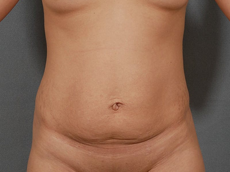 Tummy Tuck Before & After Gallery - Patient 12898852 - Image 1