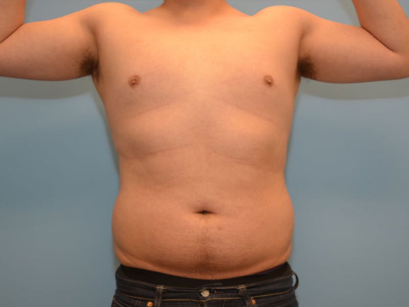 Male Liposuction Before & After Gallery - Patient 12898843 - Image 1