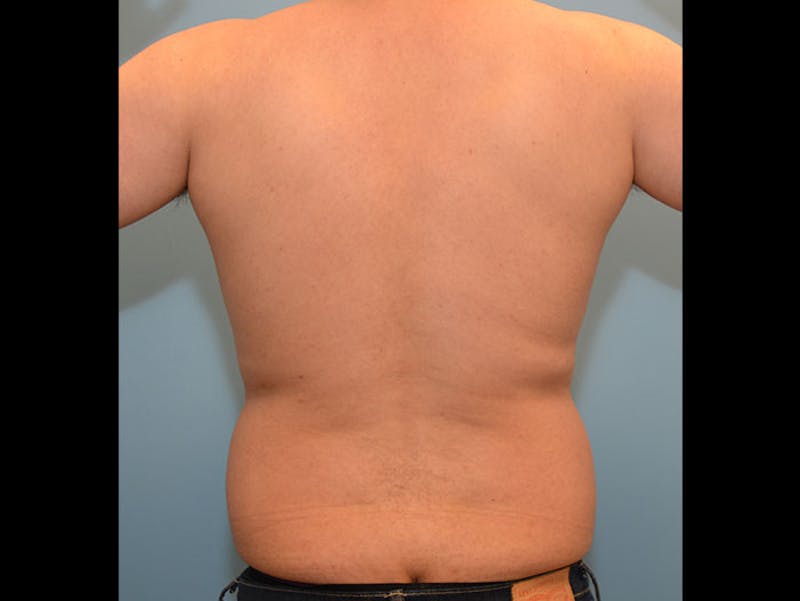 Male Liposuction Before & After Gallery - Patient 12898843 - Image 3