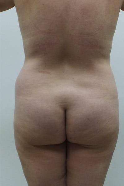 Brazilian Butt Lift Before & After Gallery - Patient 12898844 - Image 1