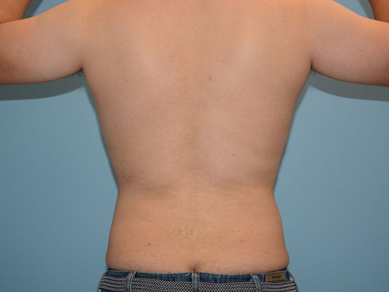 Male Liposuction Before & After Gallery - Patient 12898843 - Image 4