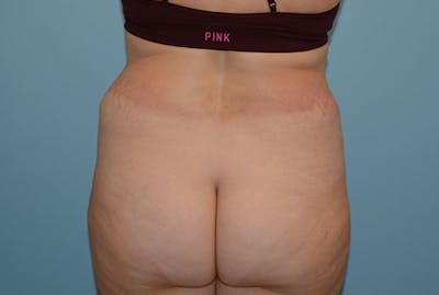 Liposuction Before & After Gallery - Patient 12898850 - Image 1