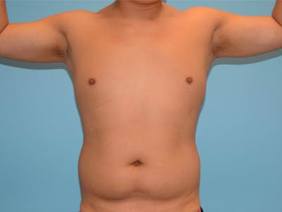 Male Liposuction Before & After Gallery - Patient 12898851 - Image 1
