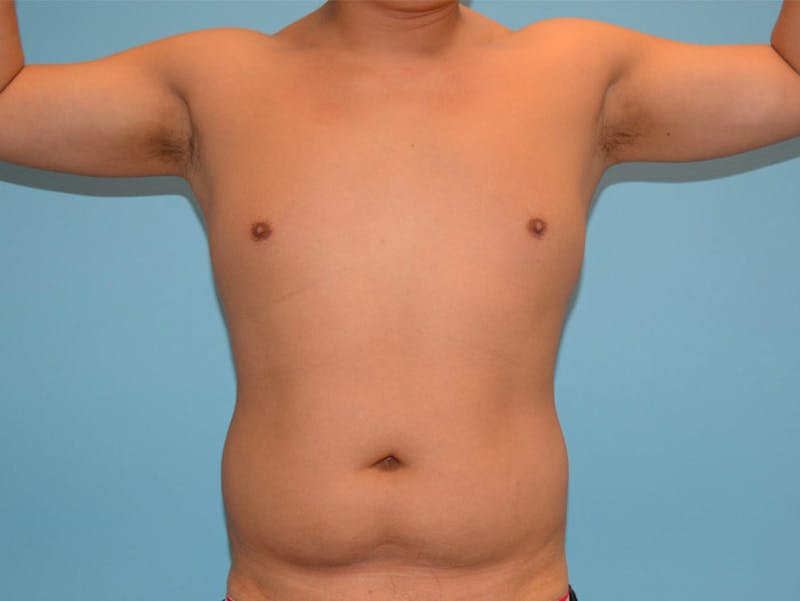 Liposuction Before & After Gallery - Patient 12898851 - Image 1