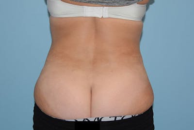Liposuction Before & After Gallery - Patient 12898850 - Image 2