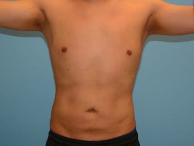 Male Liposuction Before & After Gallery - Patient 12898851 - Image 2