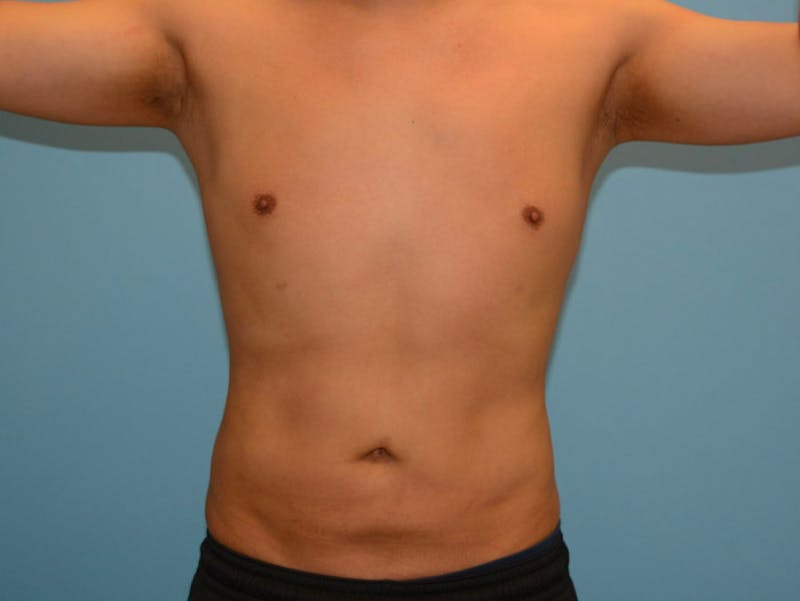 Male Liposuction Before & After Gallery - Patient 12898851 - Image 2