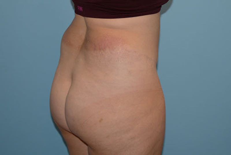 Liposuction Before & After Gallery - Patient 12898850 - Image 3