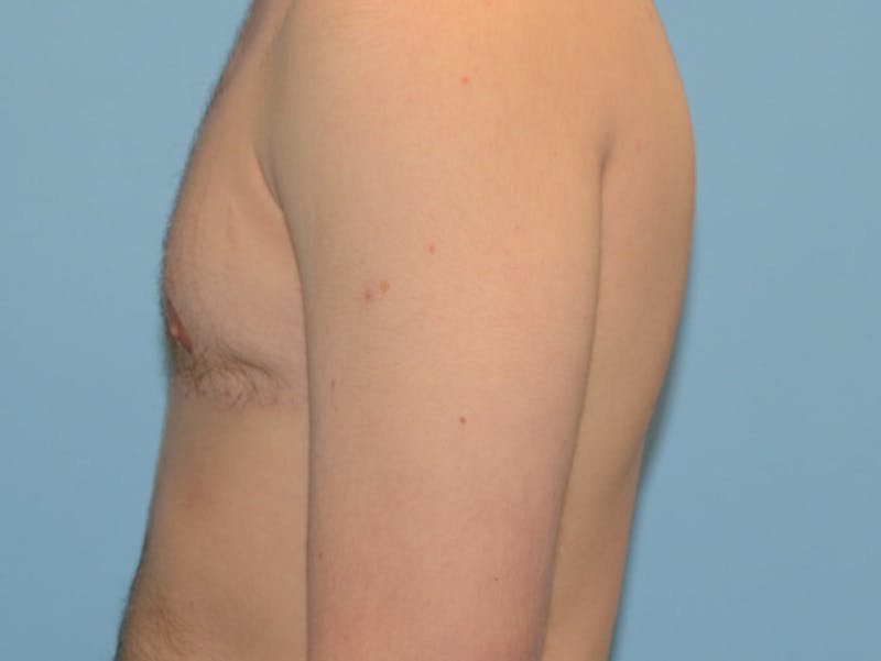 Top Surgery Before & After Gallery - Patient 12898845 - Image 6