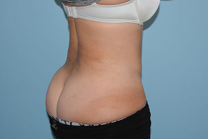 Liposuction Before & After Gallery - Patient 12898850 - Image 4