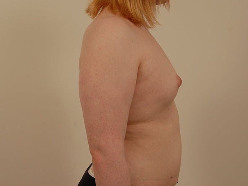 Transgender Breast Augmentation Before & After Gallery - Patient 12898847 - Image 9