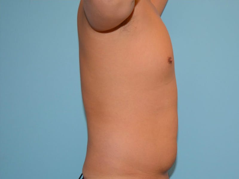 Male Liposuction Before & After Gallery - Patient 12898851 - Image 3