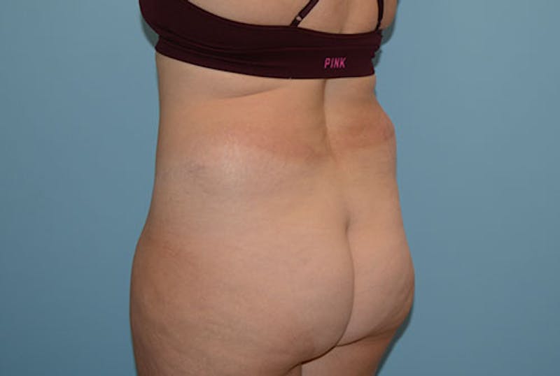Liposuction Before & After Gallery - Patient 12898850 - Image 5