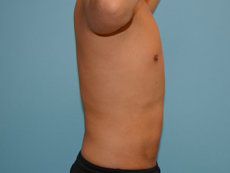 Male Liposuction Before & After Gallery - Patient 12898851 - Image 4