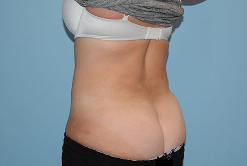 Liposuction Before & After Gallery - Patient 12898850 - Image 6