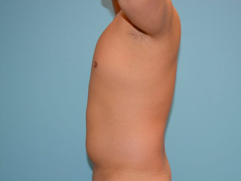 Male Liposuction Before & After Gallery - Patient 12898851 - Image 5